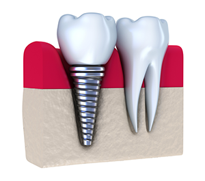 Dental Implants South Austin, Manchaca